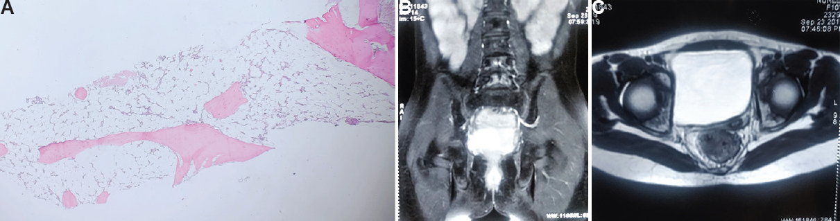 (A) Photomicrograph of the bone marrow biopsy (H and E stain, ×10) showing hypocelluar marrow with empty marrow spaces and overall cellularity of less than 5 per cent. (B) Bone marrow biopsy showing marked hypocellularity and marrow spaces replaced by fatty tissue. (C) Magnetic resonance images showing marked hypoplasia of the uterus in the transverse and cross sections.